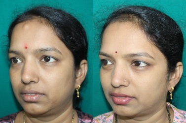 forehead osteoma removal in india